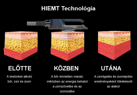 InfraSlimX Szeged - alakformálás, fogyás, méregtelenítés